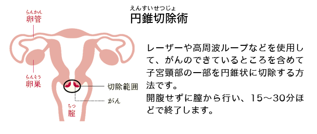 円錐切除術を経験された方。