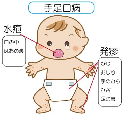 手足口病 1週間で239人 大流行の兆し 長野 ガールズちゃんねる Girls Channel