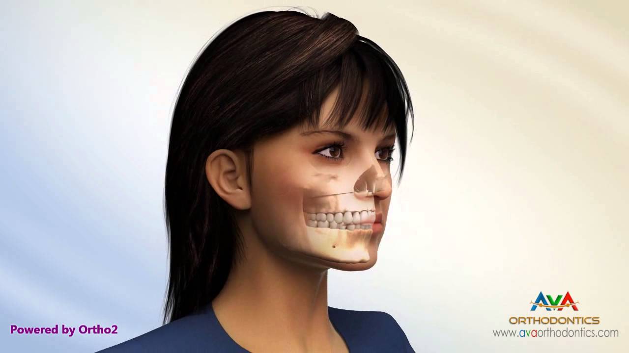 Gummy Smile Treatment by Maxillary Impaction - Surgical Orthodontics - YouTube