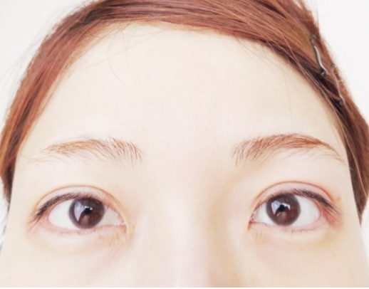 整形公表の「あいのり」桃、術後の経過を報告