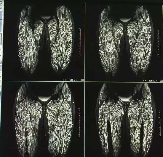 【閲覧注意】 恐怖…目の中を泳ぐ寄生虫