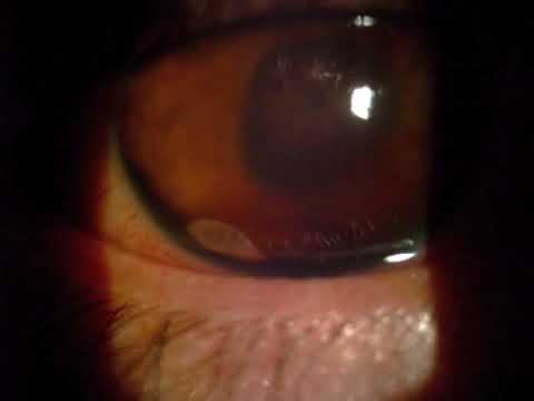 A Trematode Observed on Slit-Lamp Examination of the Eye - YouTube