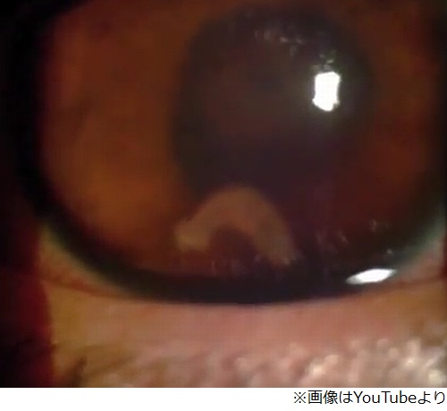 【閲覧注意】 恐怖…目の中を泳ぐ寄生虫