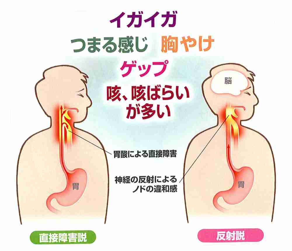 逆流性食道炎の方 ガールズちゃんねる Girls Channel