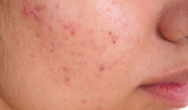   肌荒れを早く治す方法！薬やサプリに頼らないでも肌が綺麗になる生活習慣！！ | 100テク