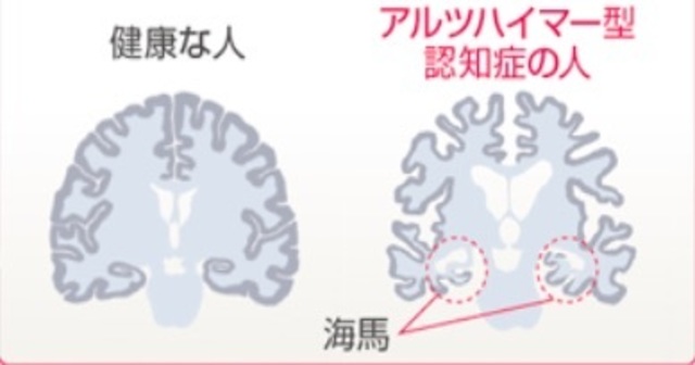   アルツハイマーの初期症状、チェックすべきポイントは怒りっぽいかどうか！？予防法も徹底解明！ | 100テク
