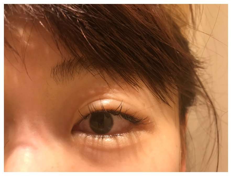 整形公表の あいのり 桃 埋没法の目は泣くとこうなる 腫れた目元を公開 ガールズちゃんねる Girls Channel