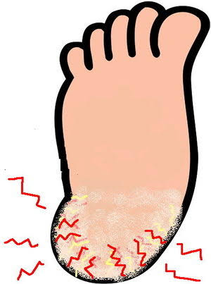 助けて！かかと割れ