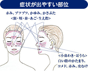 脂漏性皮膚炎で困ってる方
