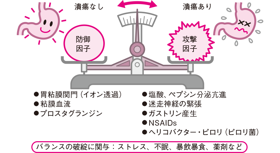 胃潰瘍・十二指腸潰瘍経験者の方