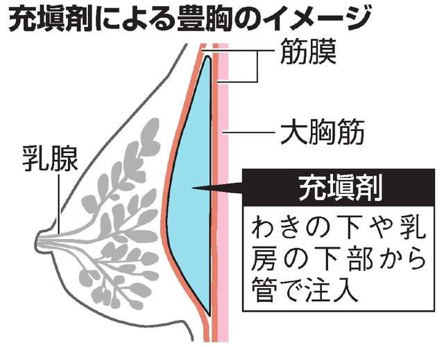 豊胸で注入の素材、相次ぐ合併症　学会が禁止の指針へ