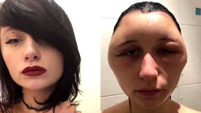 【閲覧注意】市販のヘアカラー剤を使った女性、頭が「電球」のように腫れ上がる