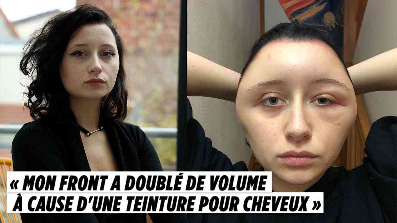 « Mon front a doublé de volume à cause d'une teinture pour cheveux » - YouTube