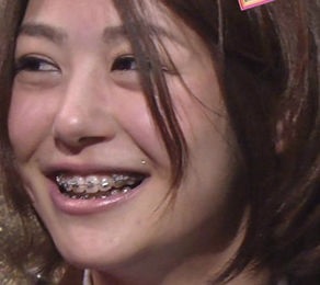 吉田明世アナ、歯の矯正に100万円以上!某局の面接で「その歯はどうするつもりですか?」