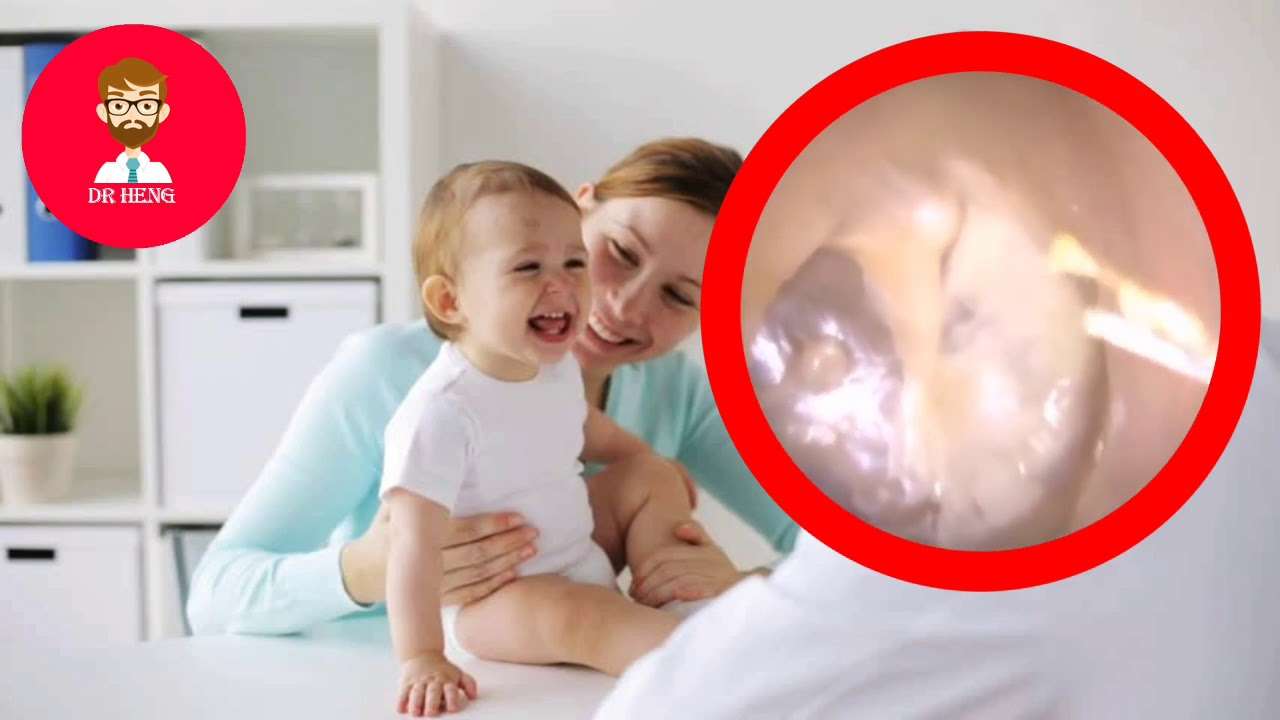 DR HENG Clean Big Ear wax Baby Blocks The Ear Canal - YouTube