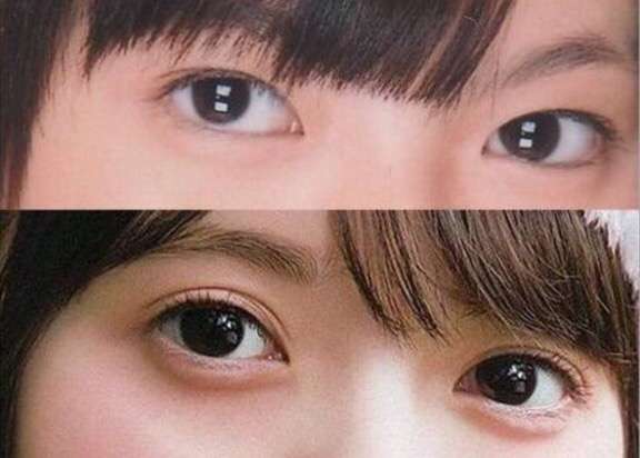 二重になりたい！