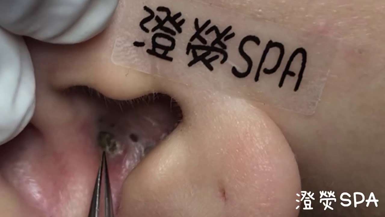 黑頭粉刺來了 More Ear Blackheads!  - 澄熒SPA - YouTube