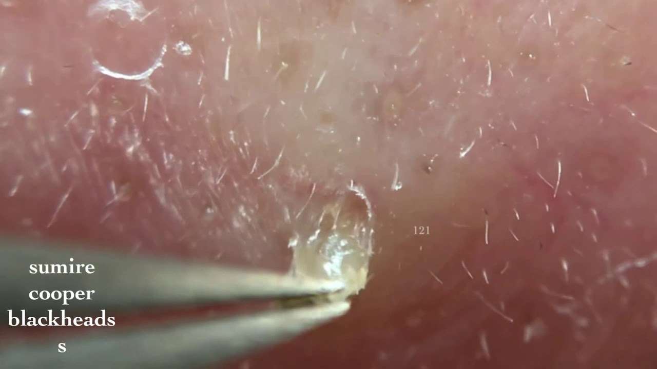 鼻角栓121.2nose blackheads(larger version)★tweezerz only★ - YouTube