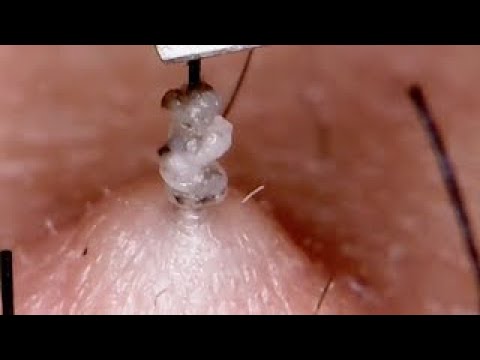 Chin Blackhead 12 顎の角栓12 - YouTube