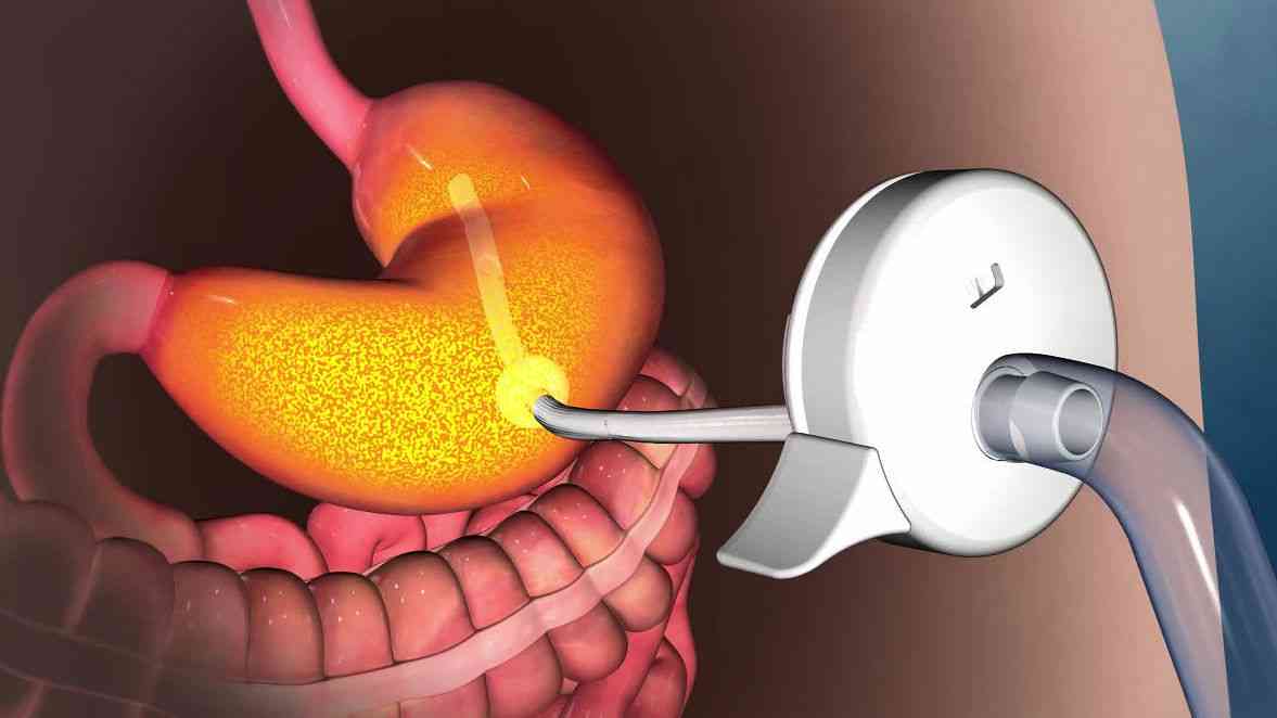 食べ物を胃の中から直接チューブで外へ出して体重を減らしダイエットを助ける「AspireAssist」 - GIGAZINE