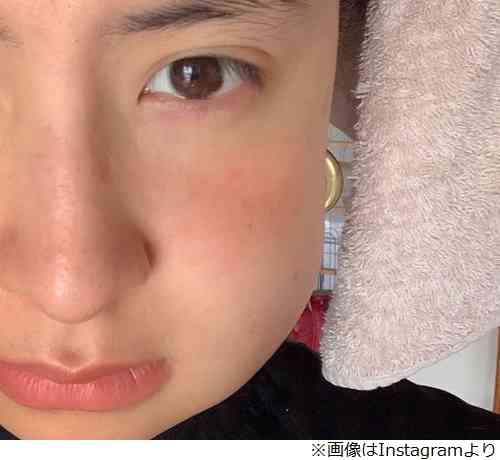 ラブリ、親知らず抜き「顔が台形です」