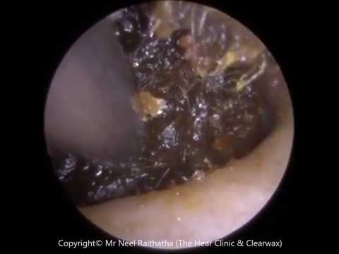 Blocked Ear Removal Extraction - YouTube