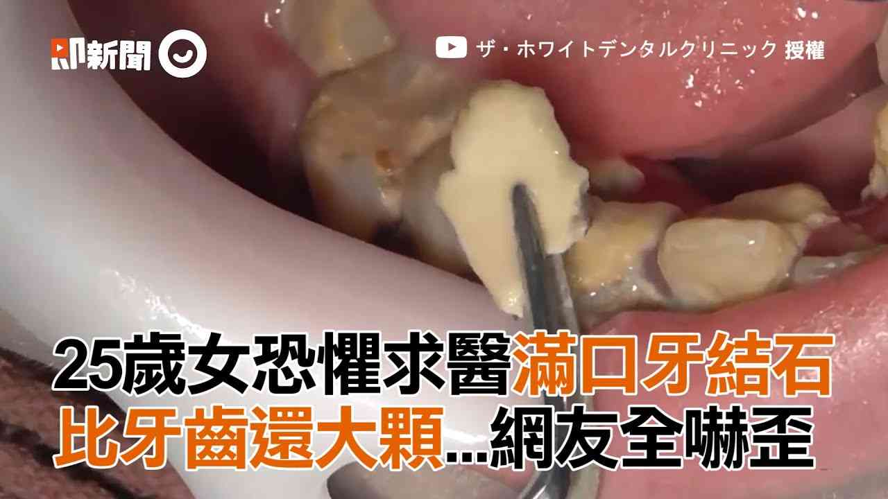 の 匂い 虫歯 治療後の被せ物から嫌な臭いがする原因とは？