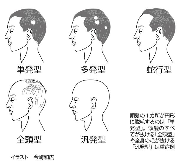 円形脱毛症になってしまった人