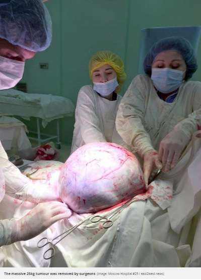 新生児約8人分、25キロの卵巣腫瘍　59歳女性から摘出（露）