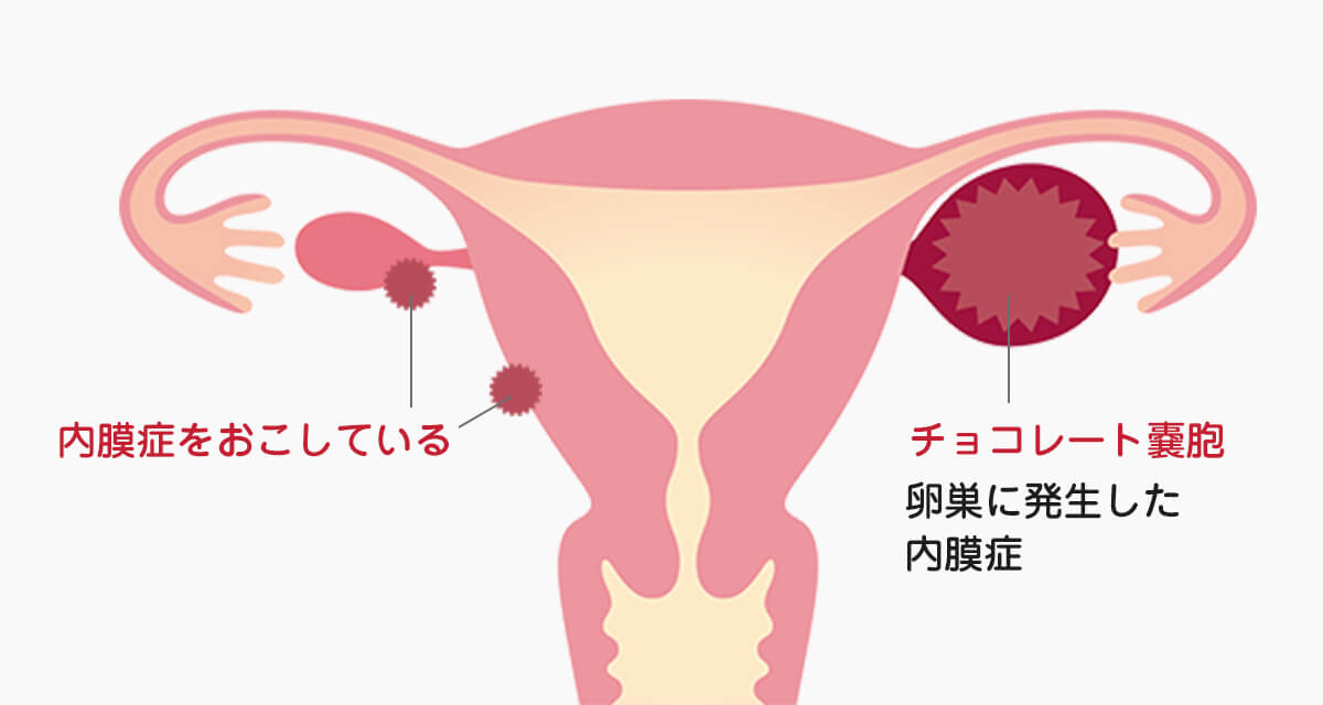 子宮内膜症について