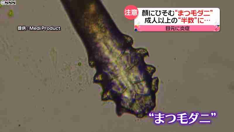 成人の約半数に寄生？“まつ毛ダニ”に注意｜日テレNEWS24