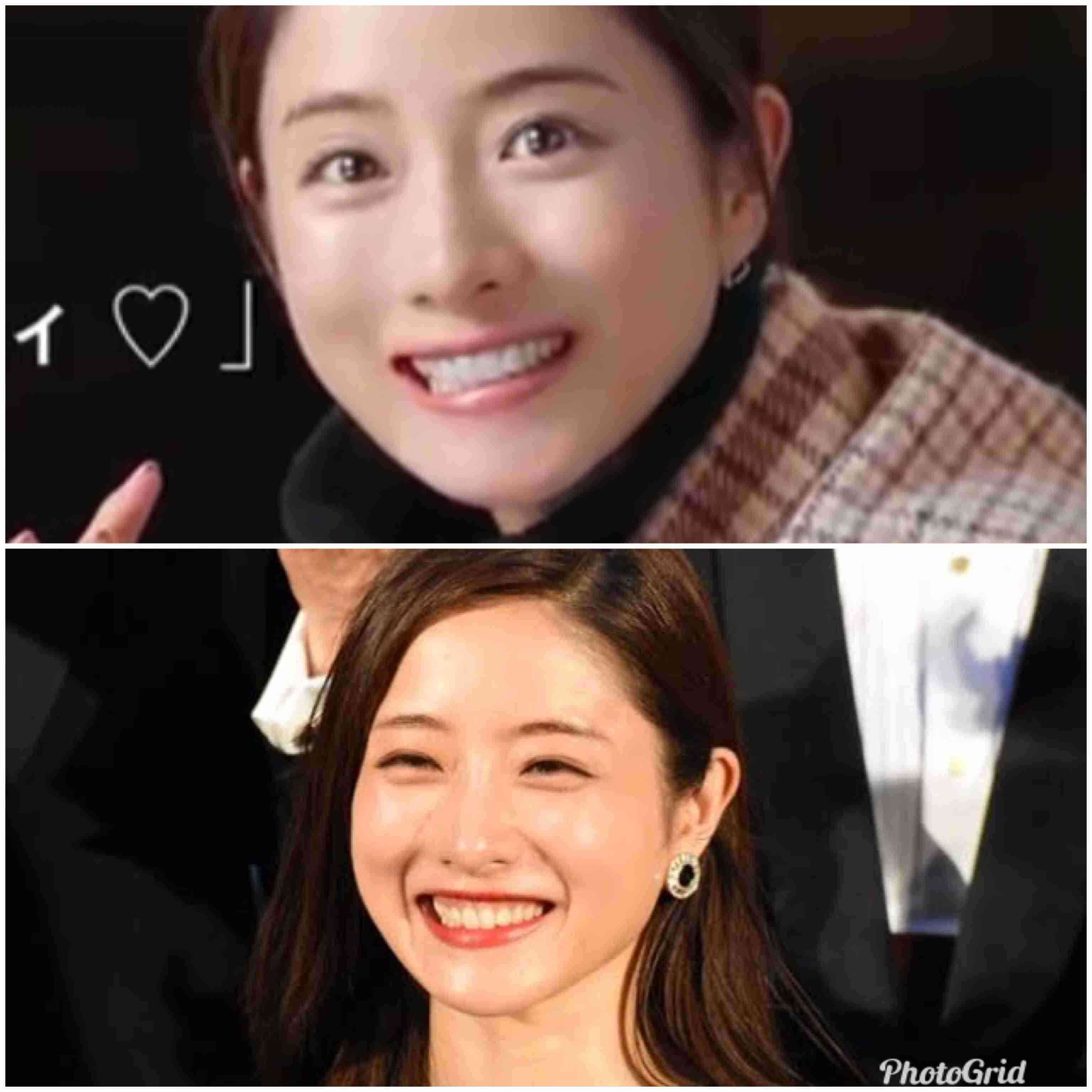 石原さとみ「整形失敗」鼻の下に違和感……新垣結衣や戸田恵梨香と同じ手術か