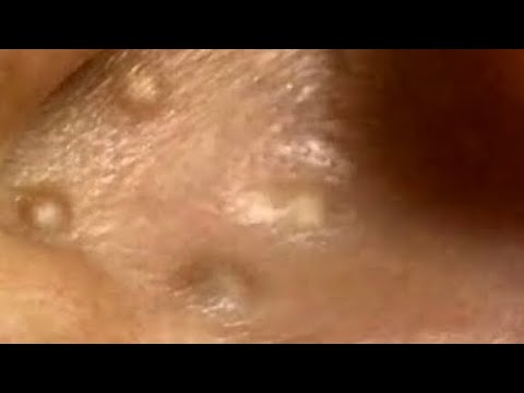 Milia - YouTube
