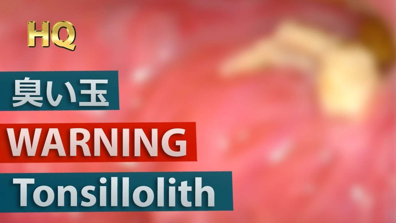 [WARNING] Big Tonsillolith(Tonsil stones) Removal Close up | 巨大膿栓(臭い玉)を除去 - YouTube