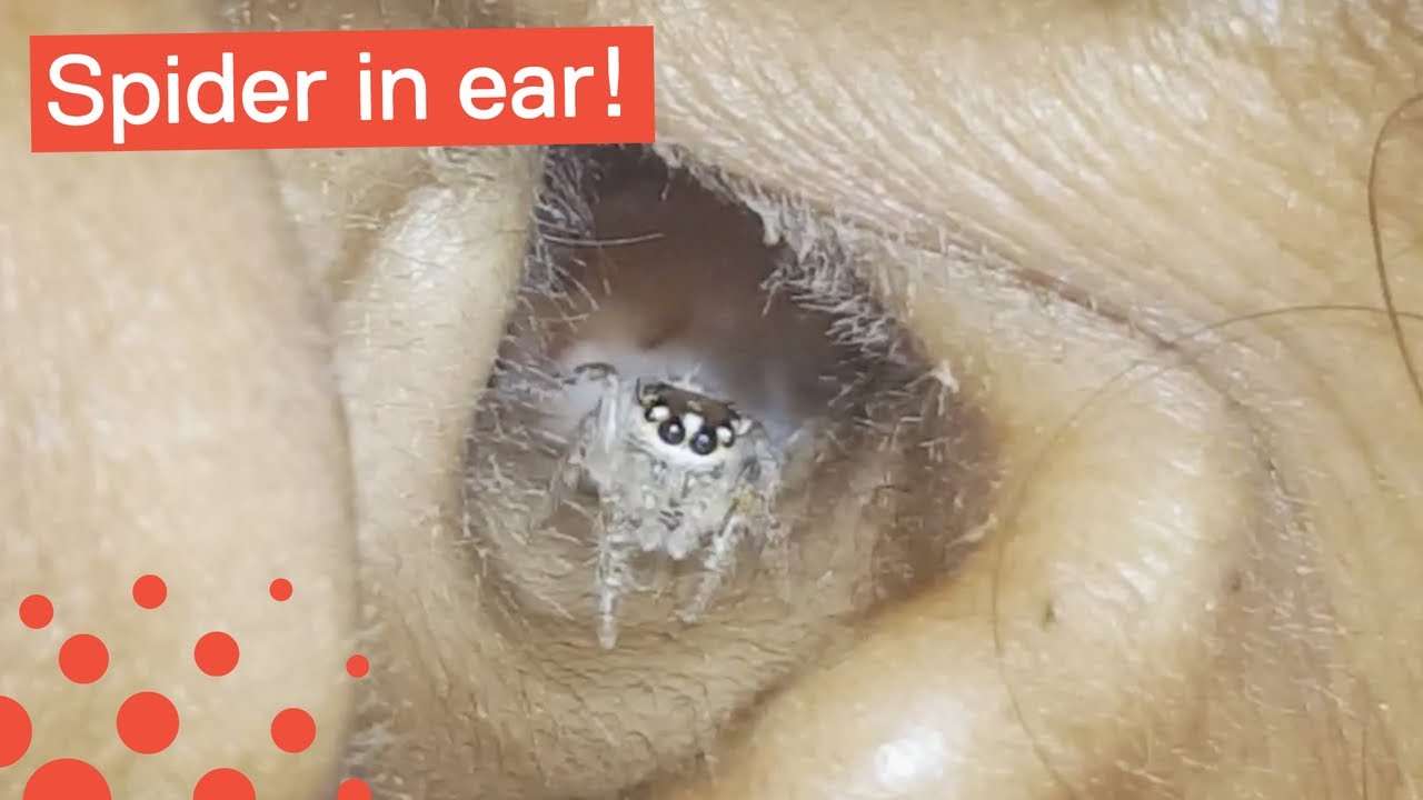 SPIDER CRAWLS OUT OF WOMAN'S EAR - YouTube