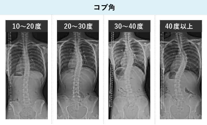 側湾症の人の相談トピ