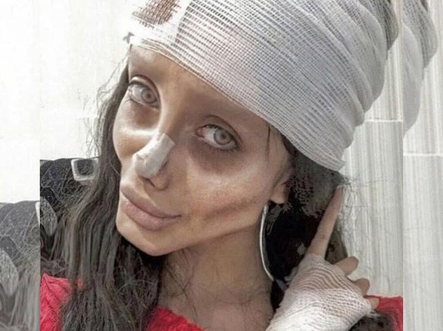 【閲覧注意】アンジェリーナ・ジョリーに憧れて50回以上の整形手術を受けた女性が逮捕