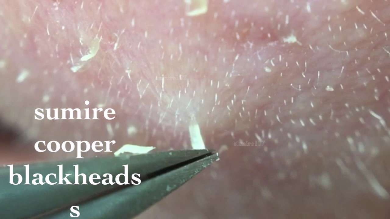 鼻角栓107.2nose blackheads（Larger version）★Tweezers only★ - YouTube