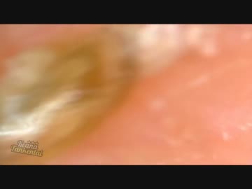 #4 頭皮(うなじ)から凄い勢いで角栓出てきた - ニコニコ動画