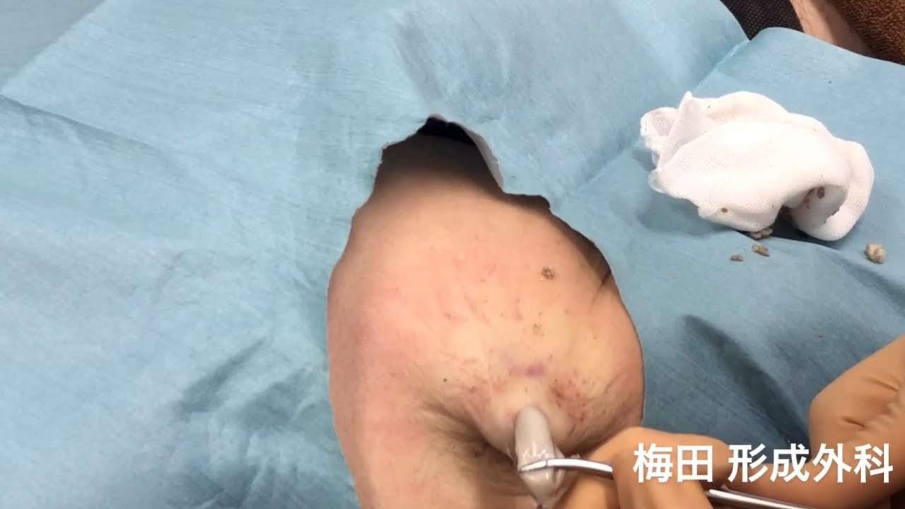 粉瘤 くり抜き法 大阪梅田形成外科 - YouTube