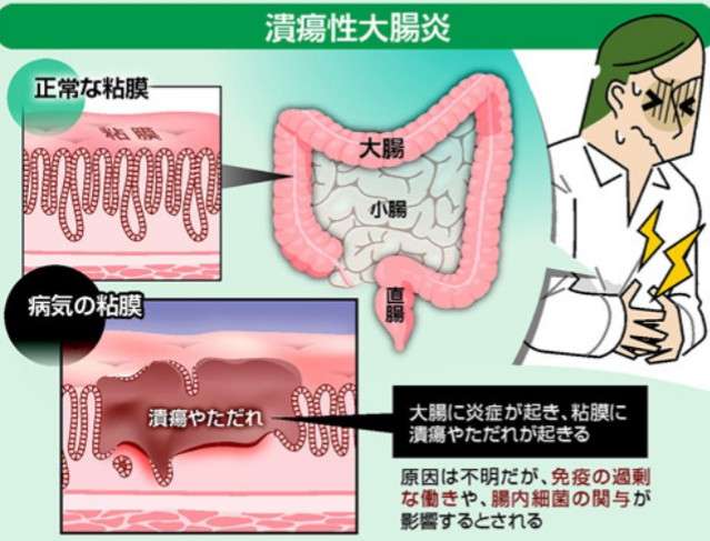 潰瘍性大腸炎の方お話しましょう(；ω；)