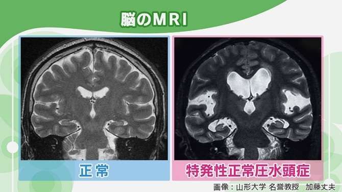認知症の原因「正常圧水頭症」とは？症状やアルツハイマーとの違い | NHK健康チャンネル