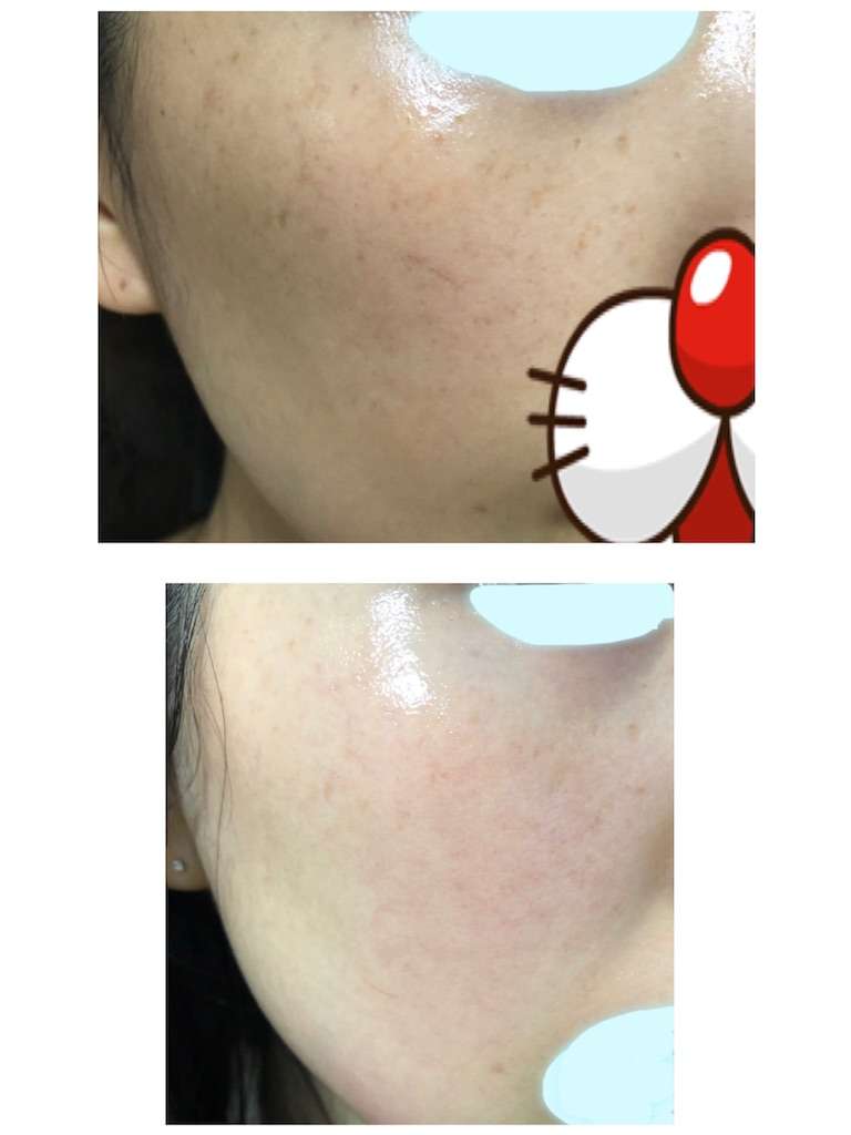 ハイドロキノン2週間経過【Life-Flo Retinol A 1% Cream 1.7oz&ハイドロキノン】シミそばかすは消えるのか？ - 永遠の２０代