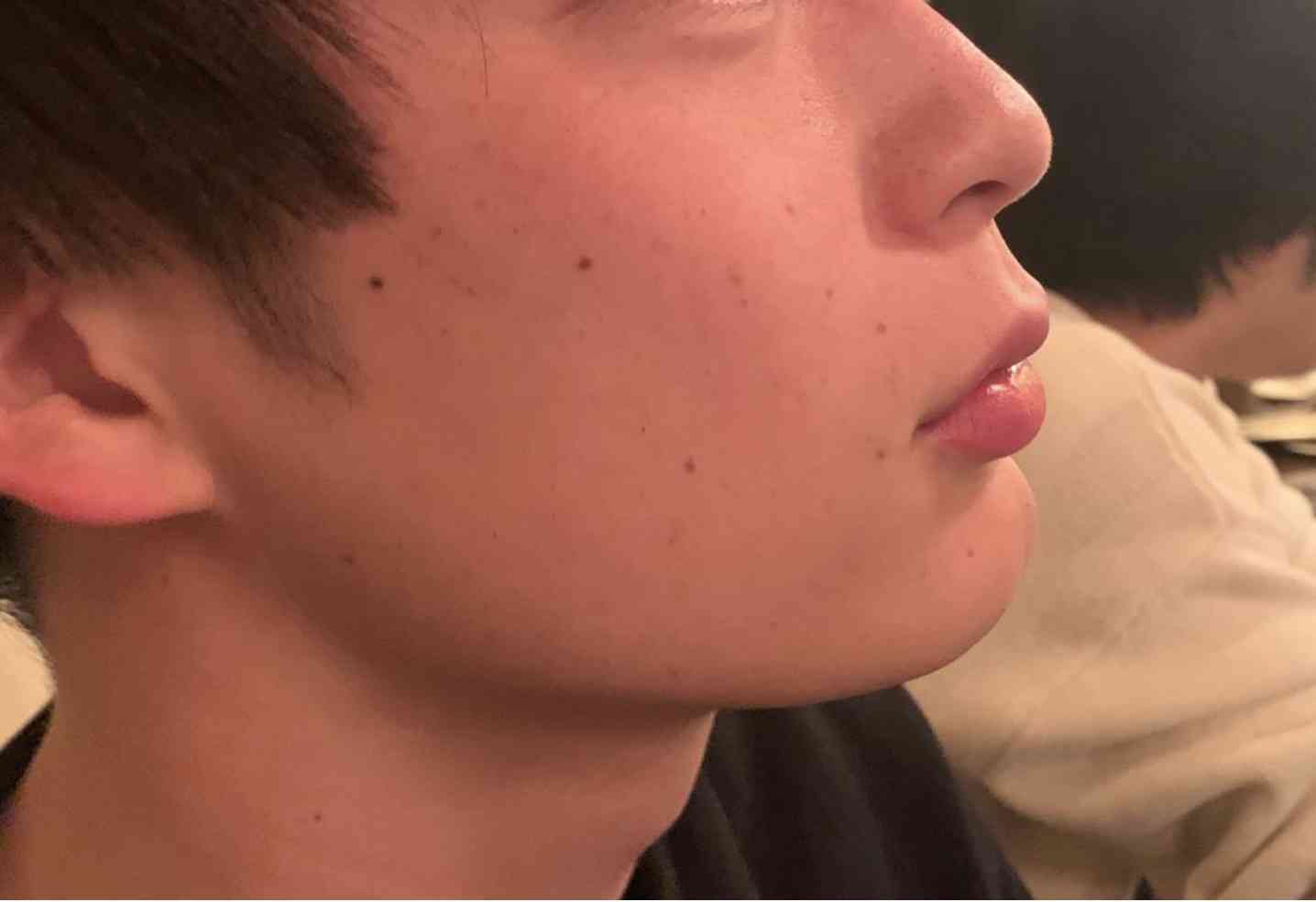 あいのり・桃、シミ取りレーザー治療を受けた彼氏の肌を公開「きれいになっておる！！！！」