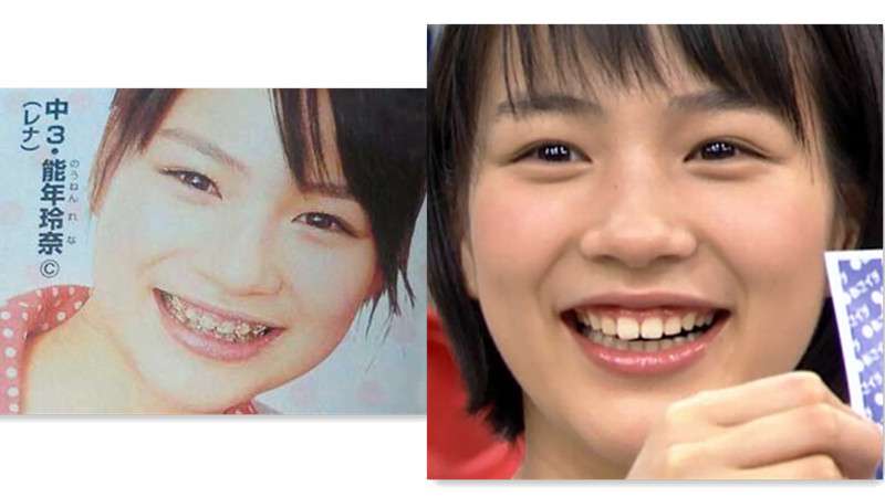 歯列矯正のビフォーアフターが見たい ガールズちゃんねる Girls Channel