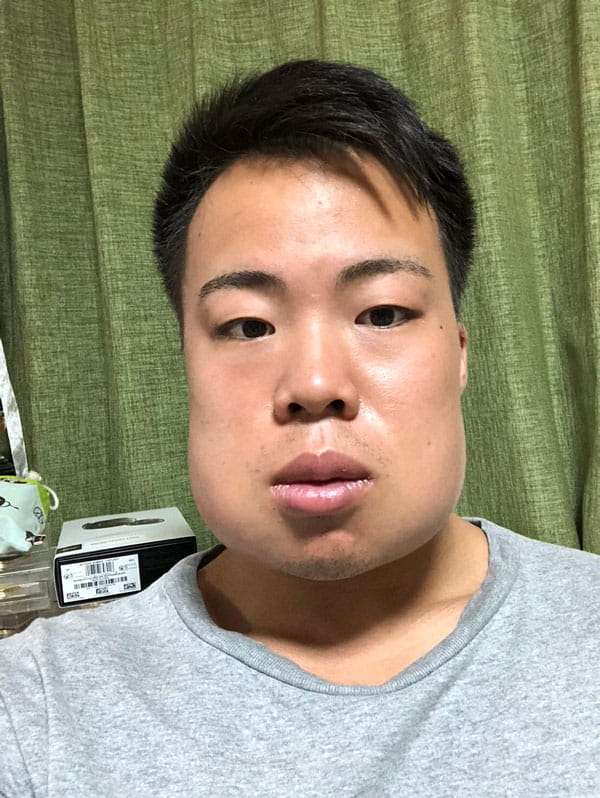 「親知らずを4本抜いた時の俺」　ヤバすぎる腫れ方に30万人の腹筋が崩壊