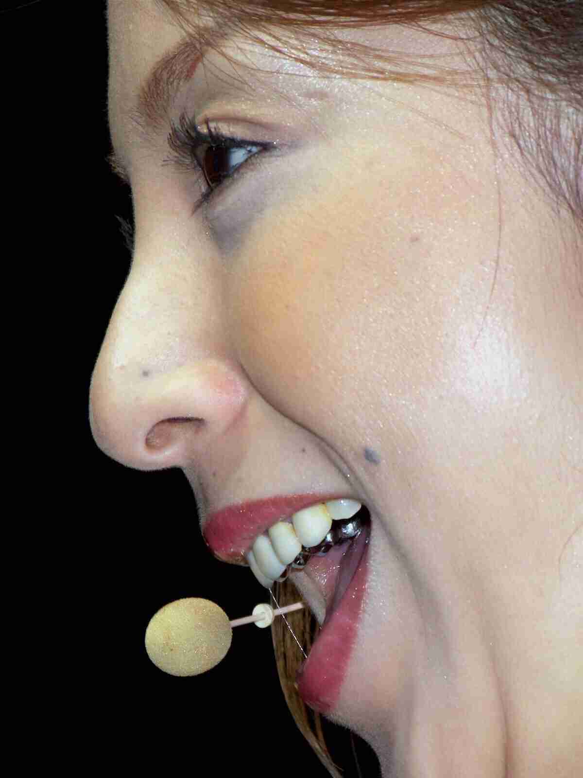 30歳以上で始める歯科矯正