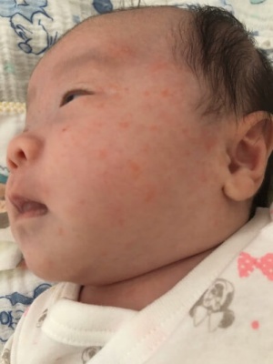 キンタロー。娘の湿疹を心配するも違うところで批判殺到(1ページ目) - デイリーニュースオンライン