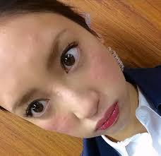 アレルギー性蕁麻疹の人