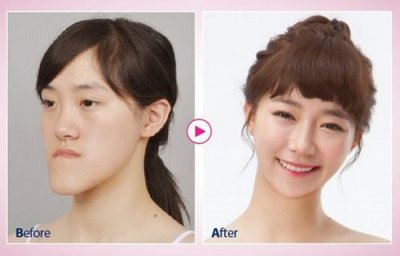 整形というかもはや別人、韓国の神業整形で中国人女子大生が美しく大変身―中国｜レコードチャイナ